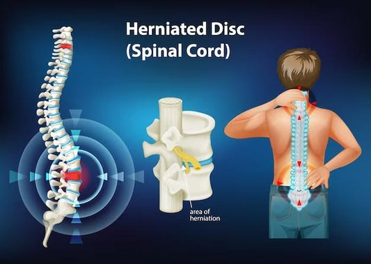 soigner une hernie discale